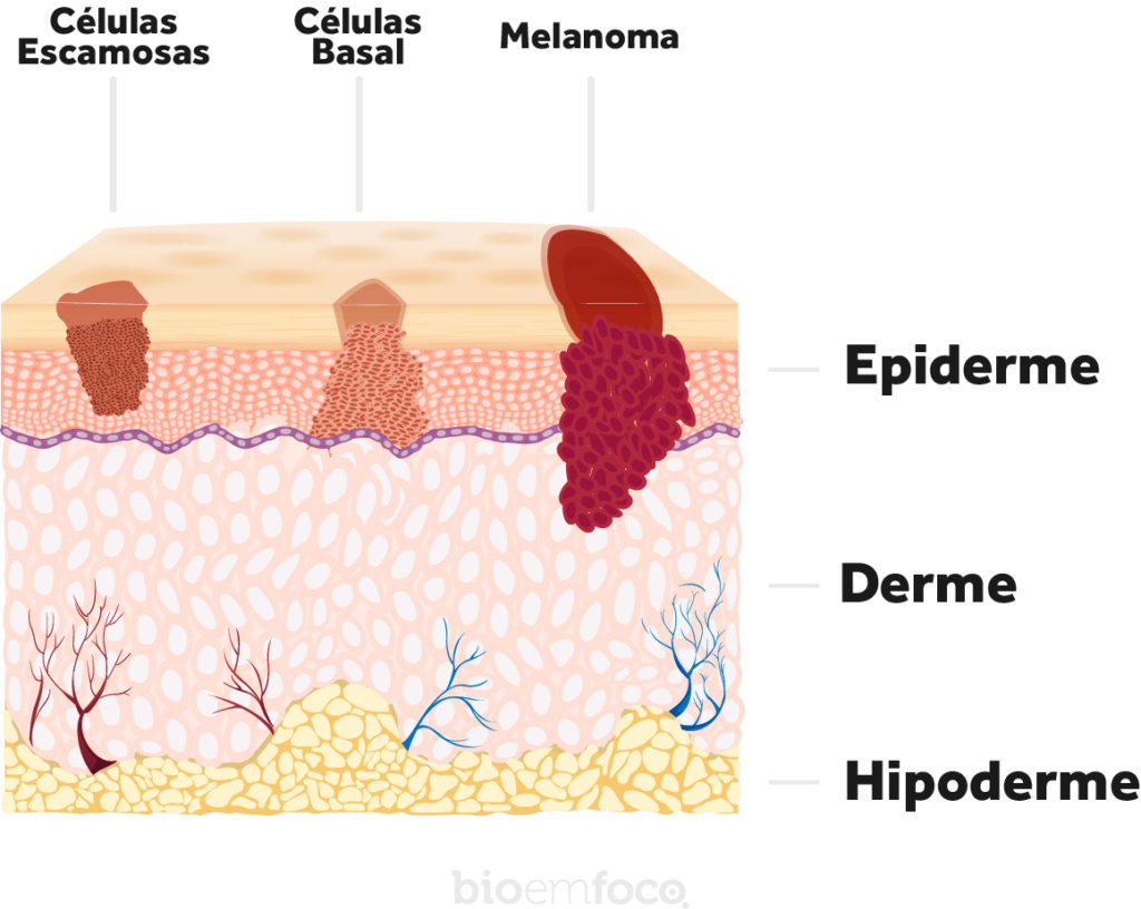 Esquema câncer de pele