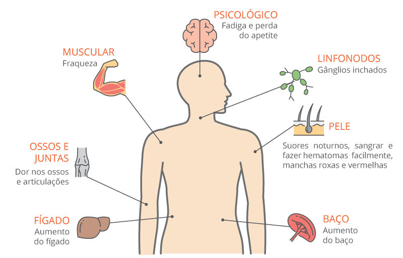 sintomas da leucemia